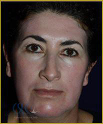 California Skin & Laser Center after Chemical Peels Treatment patient image at California