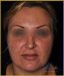 California Skin & Laser Center after Fraxel Laser Treatment patient image at California