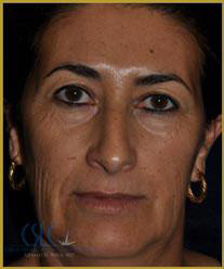 California Skin & Laser Center before Chemical Peels Treatment patient image at California