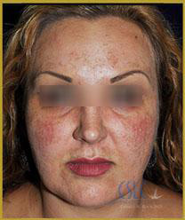 California Skin & Laser Center before Fraxel Laser Treatment patient image at California