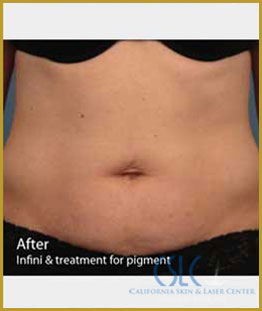 California Skin & Laser Center after Scar Removal Treatment patient image at California