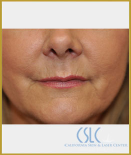 California Skin & Laser Center after Restylane, Perlane and Juvederm Treatment patient image at California