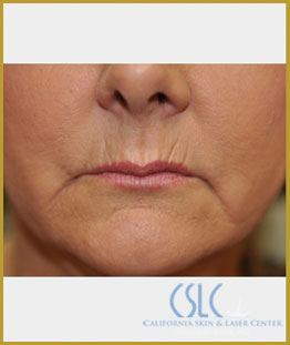 California Skin & Laser Center before Restylane, Perlane and Juvederm Treatment patient image at California