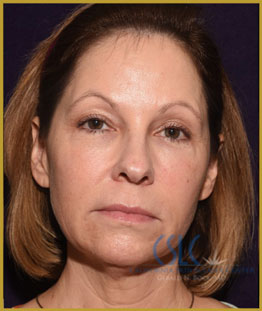 California Skin & Laser Center before J-Plasty treatments patient image at California