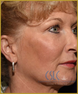 California Skin & Laser Center after Ylift treatments  patient image at California