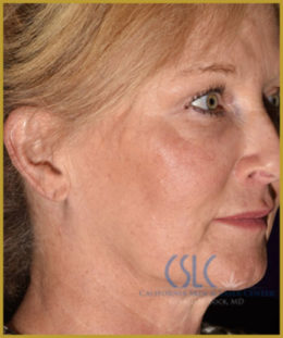 California Skin & Laser Center before Ylift treatments  patient image at California