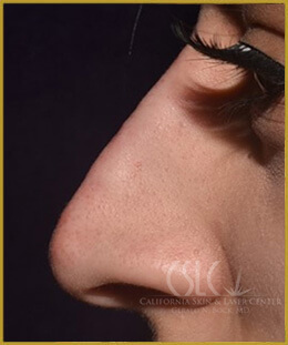 California Skin & Laser Center after Nose Filler treatments  patient image at California