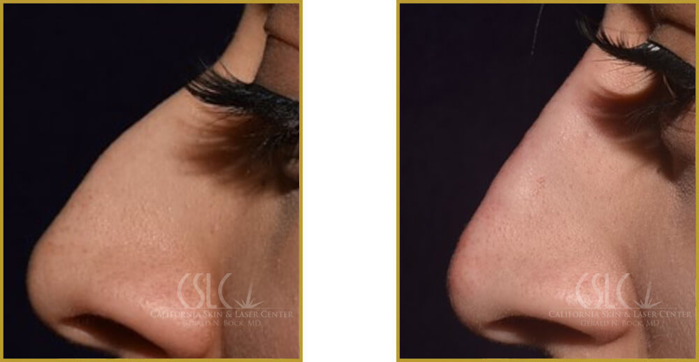 Nose Filler Treatment before and after images - Dr. Gerald Bock