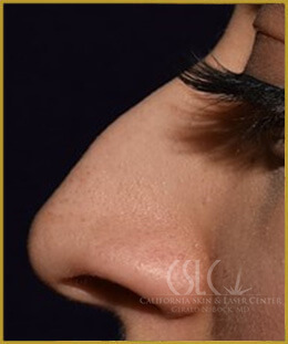 California Skin & Laser Center before Nose Filler treatments  patient image at California