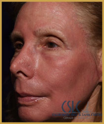 California Skin & Laser Center after Croton Oil Peel Treatment patient image at California