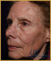 California Skin & Laser Center before Croton Oil Peel Treatment patient image at California