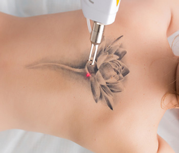 10 important facts you might not know about laser tattoo removal in Stockton, CA
