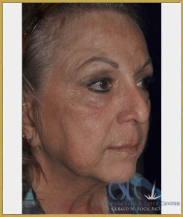 Photo Facial/ IPL/ BBL - Before and After Actual patient result Case-1, Before Image at California Skin & Laser Center, CA
